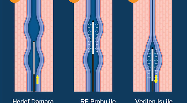 Radyofrekansla Varis Tedavisi