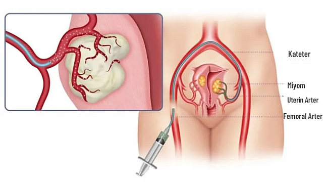 Ameliyatsız Miyom Tedavisi
